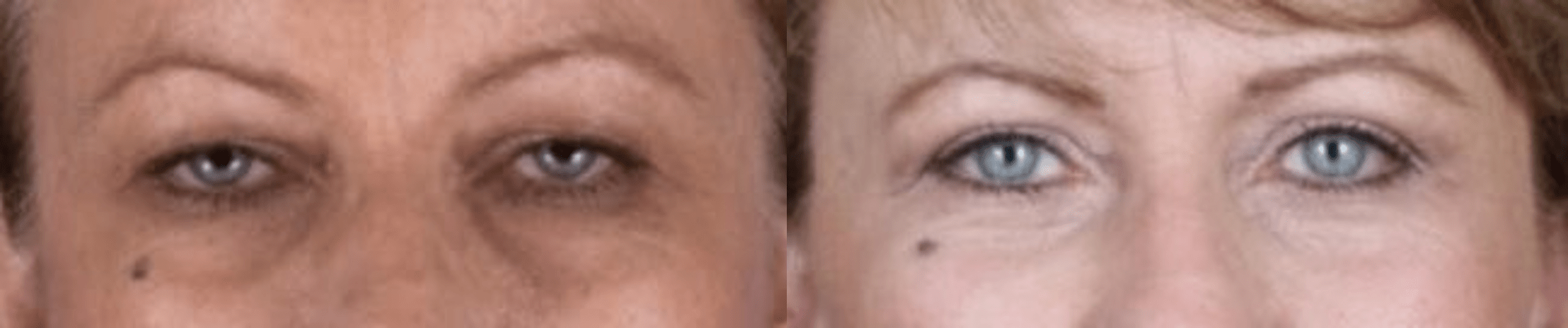 Quad Blepharoplasty Before and After to Rejuvenate the Eyelids