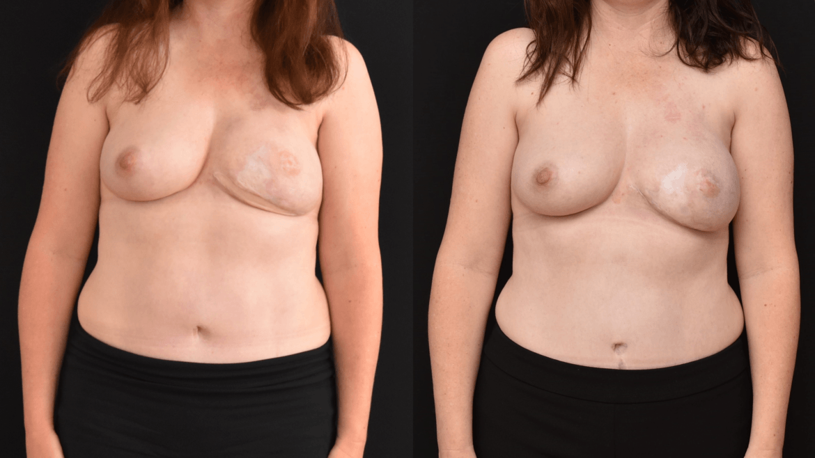 Left Breast DIEP Flap Revision. Correction of Mastectomy Symmastia and Implant Augmentation of DIEP Flap