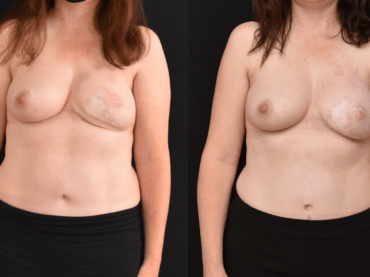 Left Breast DIEP Flap Revision. Correction of Mastectomy Symmastia and Implant Augmentation of DIEP Flap