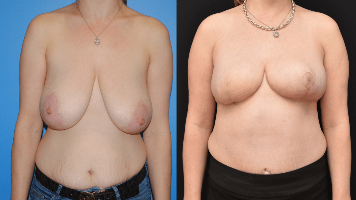 Right Breast Reconstruction Following Mastectomy with DIEP Flap, Deep Inferior Epigastric Artery Perforator Flap