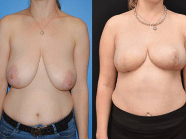 Right Breast Reconstruction Following Mastectomy with DIEP Flap, Deep Inferior Epigastric Artery Perforator Flap