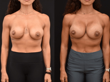 Secondary Breast Augmentation to Improve Rippling and Overall Breast Aesthetics