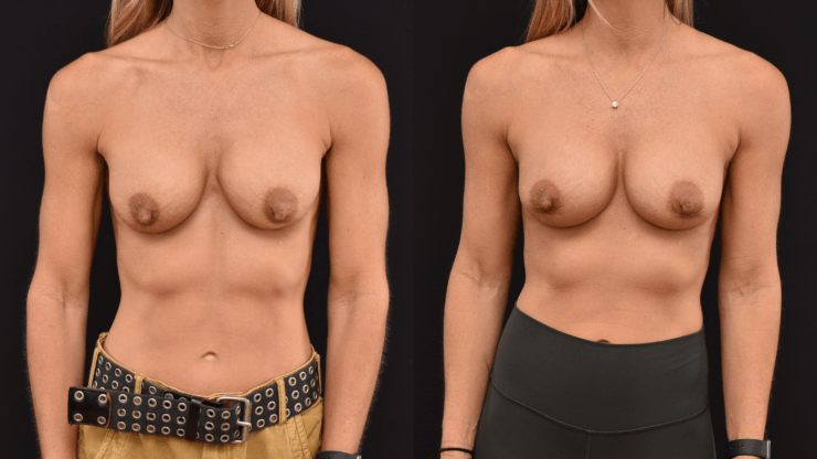 Capsular Contracture Surgery & Implant Rupture. Secondary Breast Augmentation