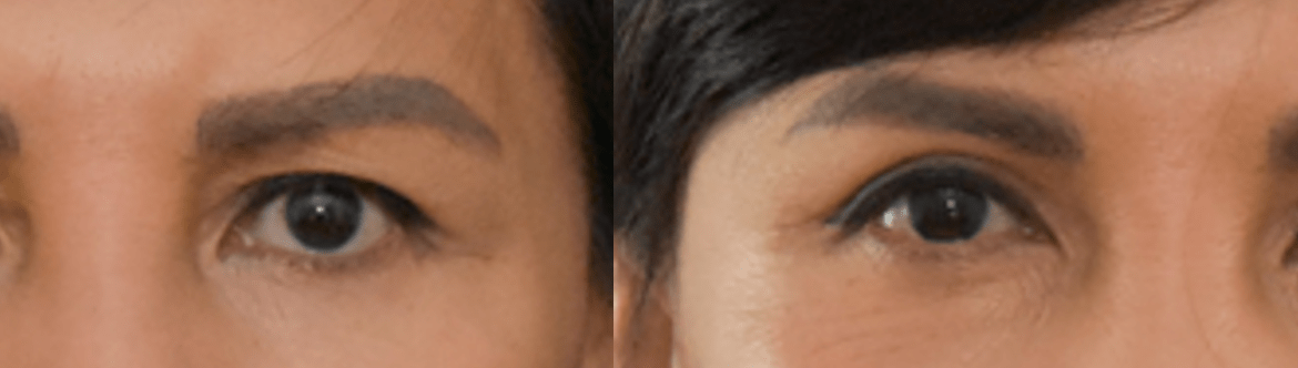 Upper Blepharoplasty of Asian Eyelid