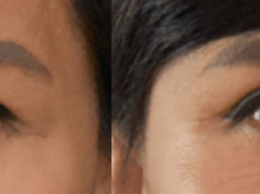 Upper Blepharoplasty of Asian Eyelid