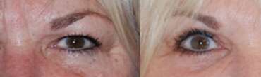 The Upper & Lower Eyelid Blepharoplasty for Facial Rejuvenation