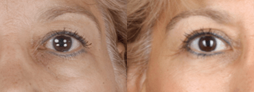 Upper & Lower Blepharoplasty for Facial Rejuvenation