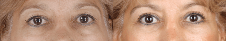 Upper & Lower Blepharoplasty for Facial Rejuvenation