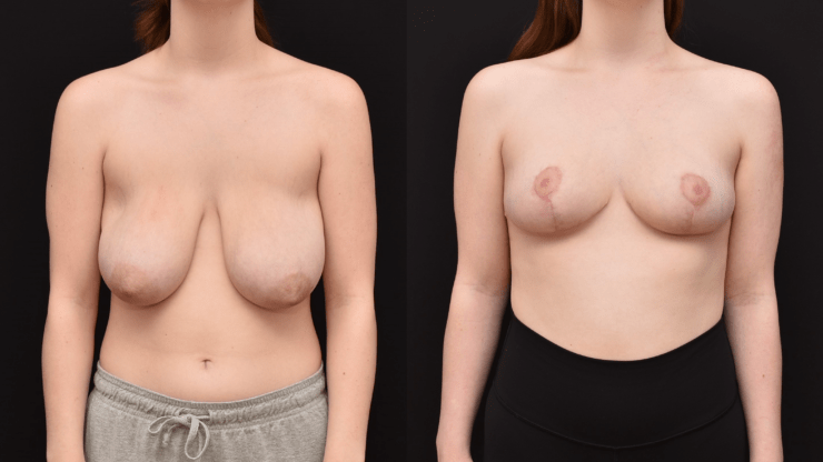 Bilateral Mastopexy & Breast Reduction