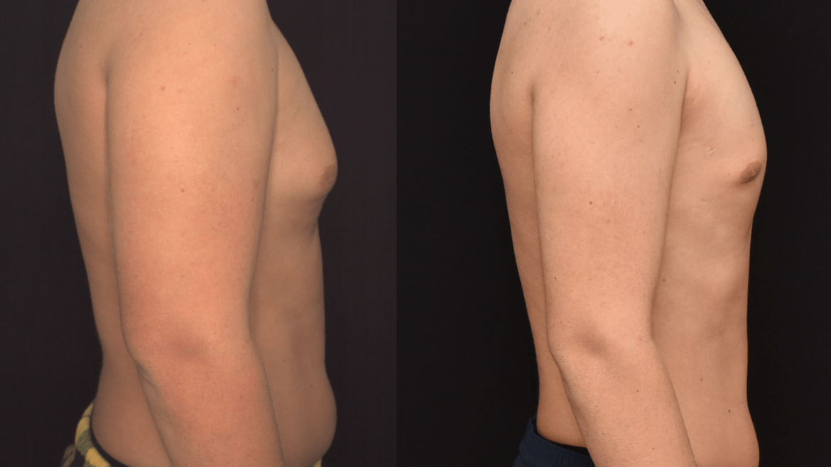 Liposuction for Gynecomastia & Weight Loss for Overall Health