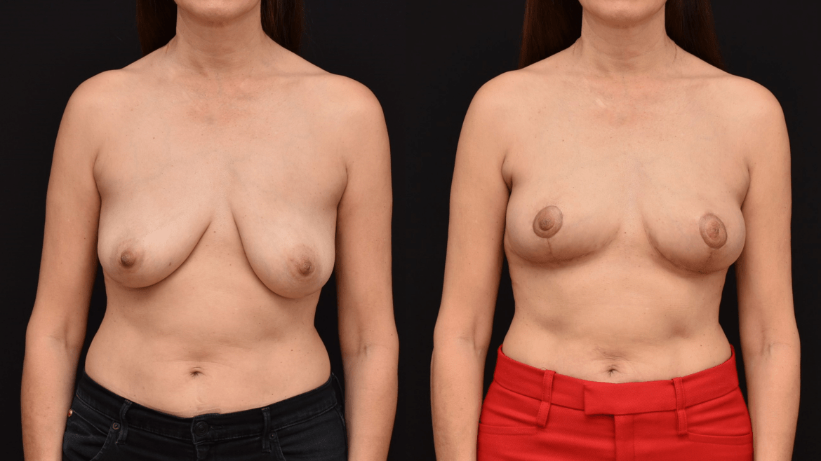 Oncoplastic Reconstruction of Lumpectomy Defects for Breast Cancer