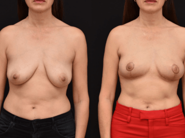 Oncoplastic Reconstruction of Lumpectomy Defects for Breast Cancer