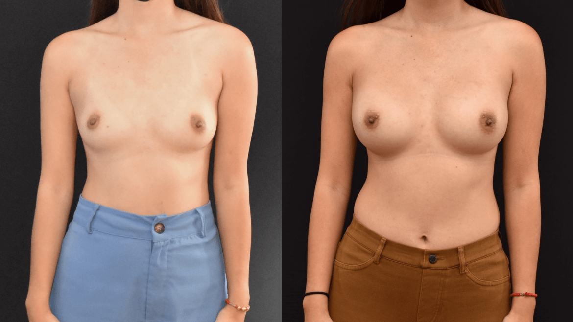 Trans-axillary Breast Augmentation