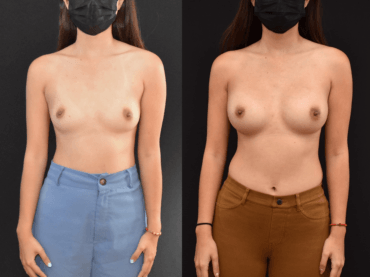 Trans-axillary Breast Augmentation