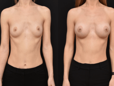 Breast Augmentation in Yoga-Pilates Body Types