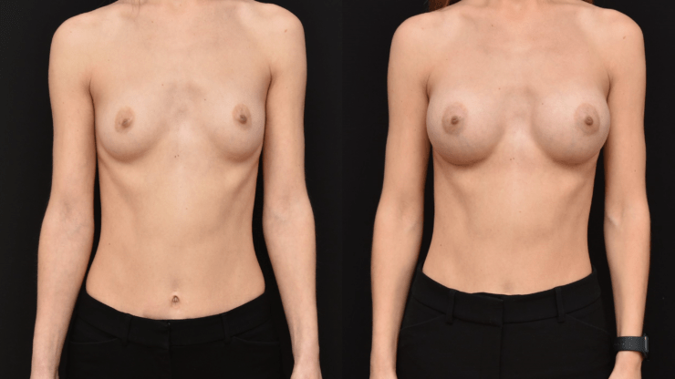 Breast Augmentation in Yoga-Pilates Body Types