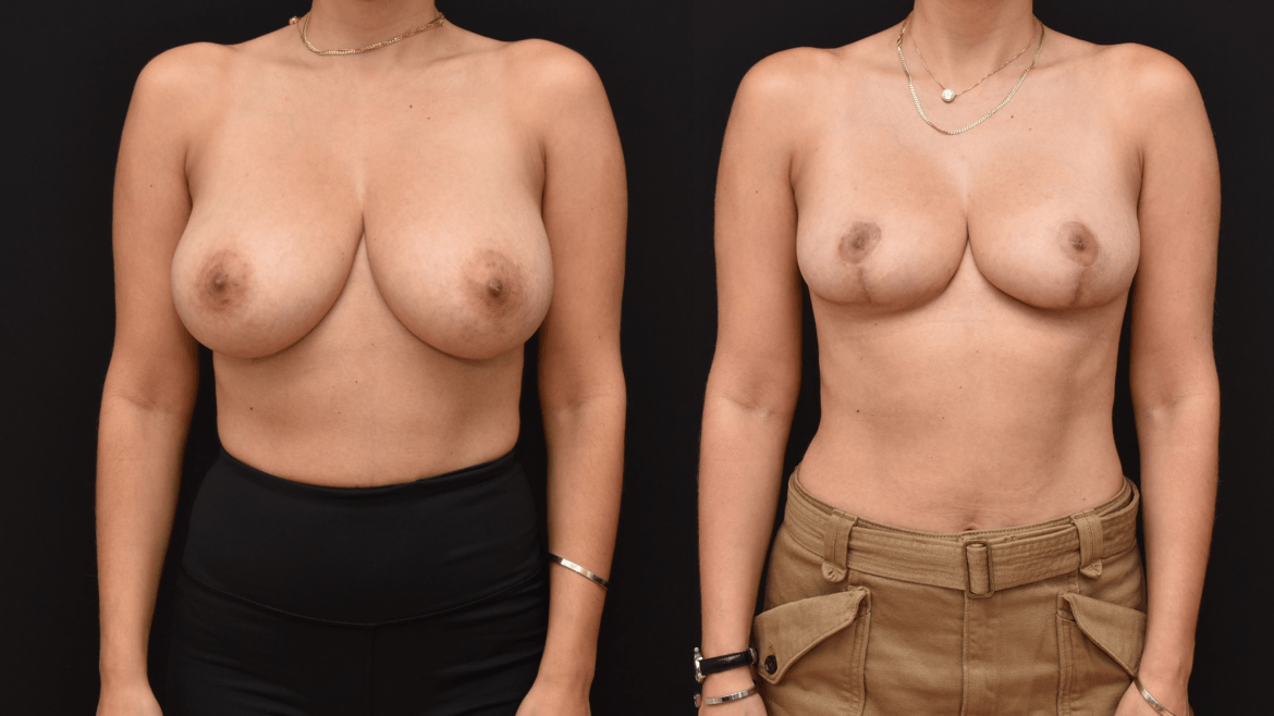 Breast Reduction and Mastopexy Surgery