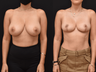 Breast Reduction and Mastopexy Surgery