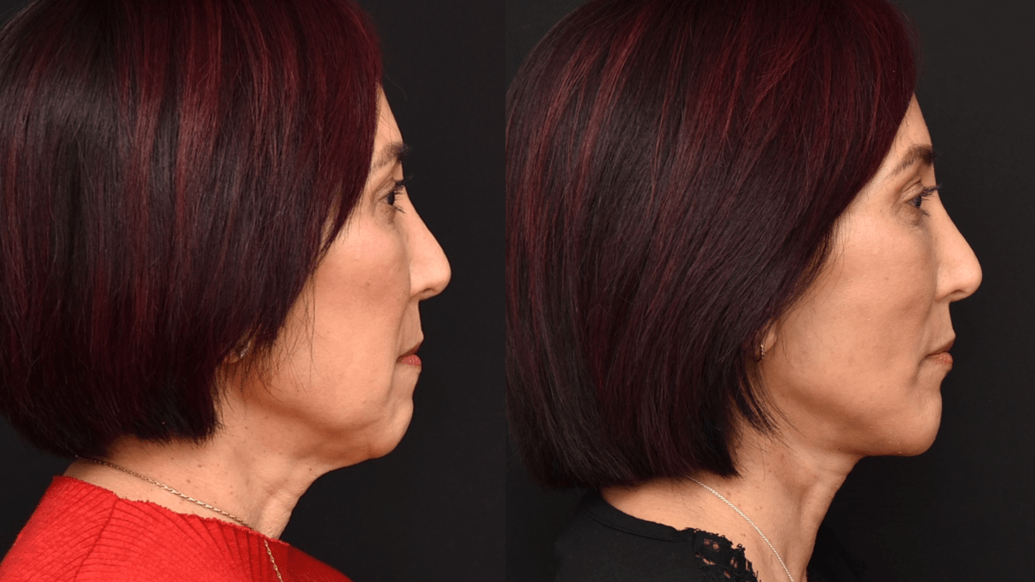Lower Face and Neck Lift Surgery