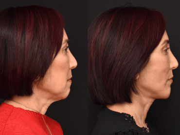 Lower Face and Neck Lift Surgery