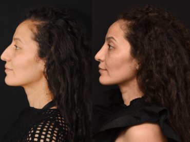 Rhinoplasty to Improve a Dorsal Hump