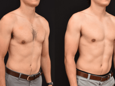 Bilateral Gynecomastia Excision via Peri-areolar Incision.