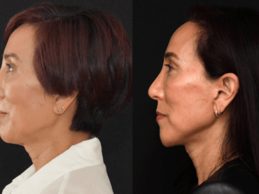 Lower Face and Neck Lift Surgery for Neck Contour