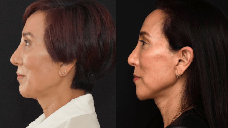 Lower Face and Neck Lift Surgery for Neck Contour