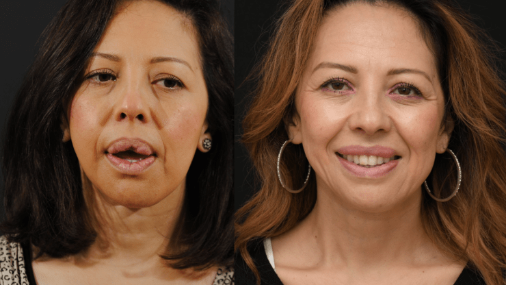 Lip Reconstruction