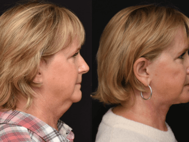 Lower Face and Neck lift Surgery to Rejuvenate the Face