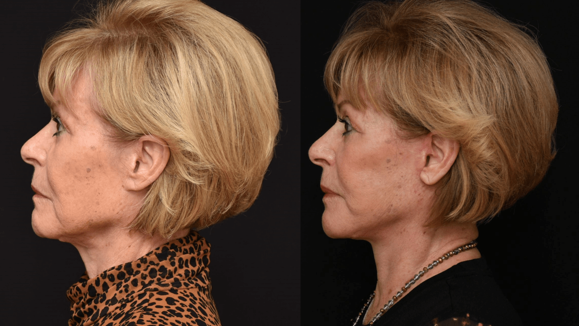 Lower Face and Neck Lift for Facial Rejuvenation