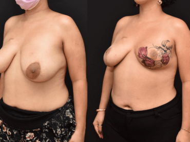 Oncoplastic Reconstruction of Lumpectomy Defects and Aesthetic Tattoos.