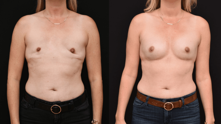 Bilateral Implant Reconstruction for Mastectomy