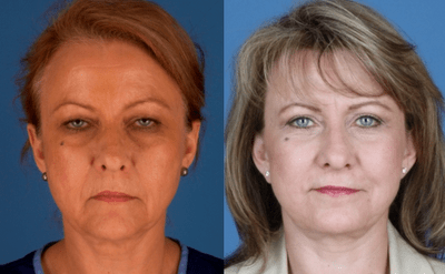 Upper and Lower Blepharoplasty to Improve the tired appearance of the Eyes
