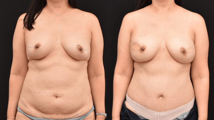 Bilateral Mastectomy Breast Reconstruction with DIEP Flap