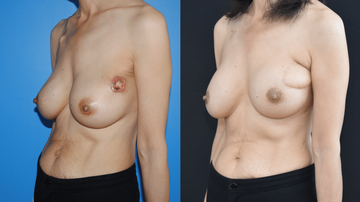Lumpectomy Reconstruction with Latisimus Dorsi Flap Reconstruction