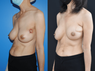 Lumpectomy Reconstruction with Latisimus Dorsi Flap Reconstruction