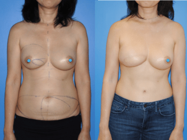 Mastectomy Reconstruction with DIEP Flap