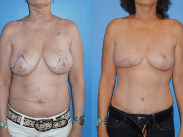 DIEP Flap Breast Reconstruction