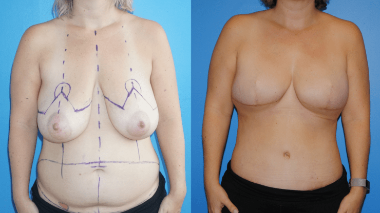 Bilateral DIEP Flap Breast Reconstruction