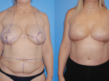 Bilateral Immediate DIEP Flap Breast Reconstruction