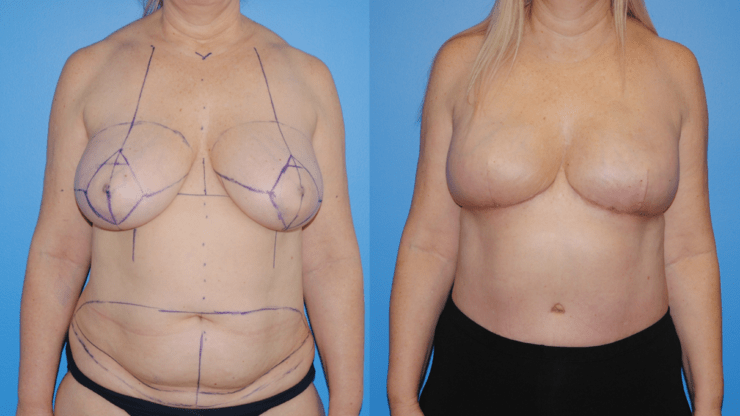 Bilateral Immediate DIEP Flap Breast Reconstruction