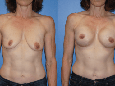 Bilateral Mastectomy Breast Reconstruction