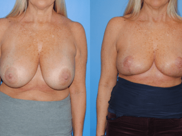 Removal of Bilateral Implants and Mastopexy, A Step-Wise Sequence to Mastectomy.