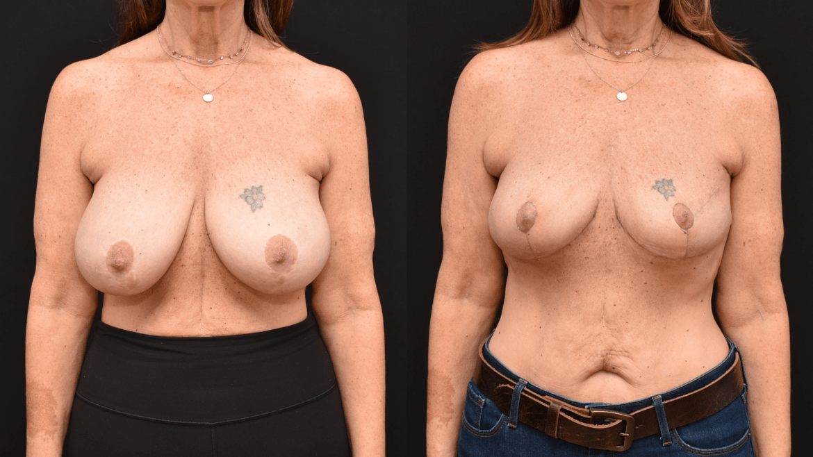 Implant Removal, Mastopexy, and Oncoplastic Closure of Lumpectomy Defects