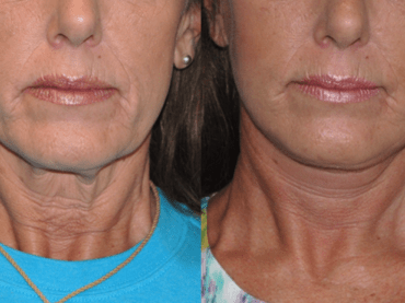 Lower Face & Neck Lift Surgery