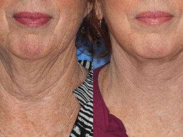 The Lower Face & Neck Lift