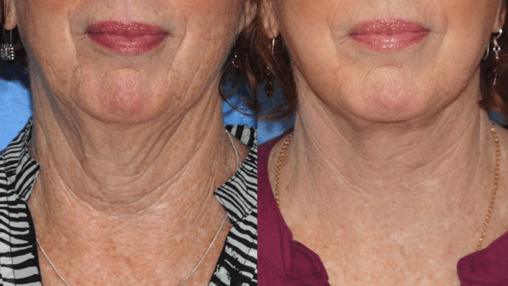 The Lower Face & Neck Lift