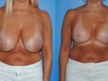 Removal of Mammary Prosthesis and Breast Lift