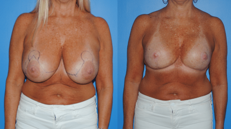 Removal of Mammary Prosthesis and Breast Lift